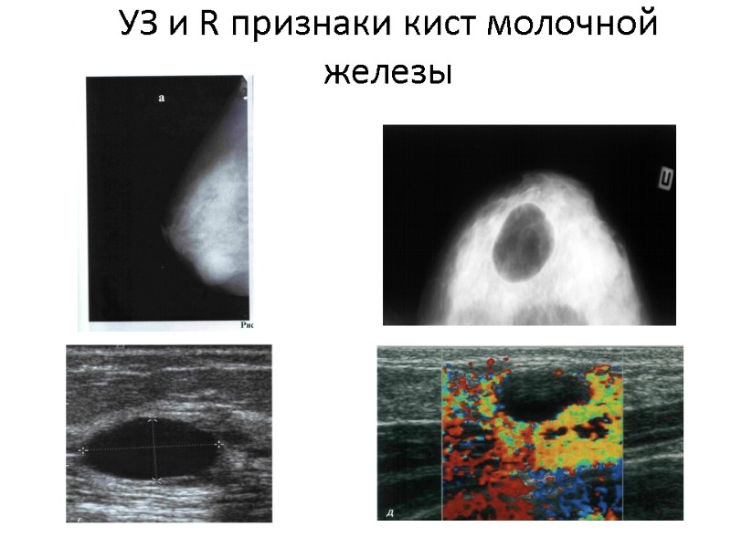 УЗ и R признаки кист молочной железы
